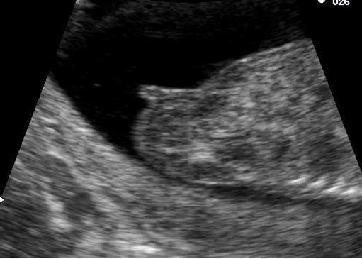 Ultrassom mostrando o tubérculo genital (14 semanas) — crédito: Mirmillon / Wikimedia Commons.