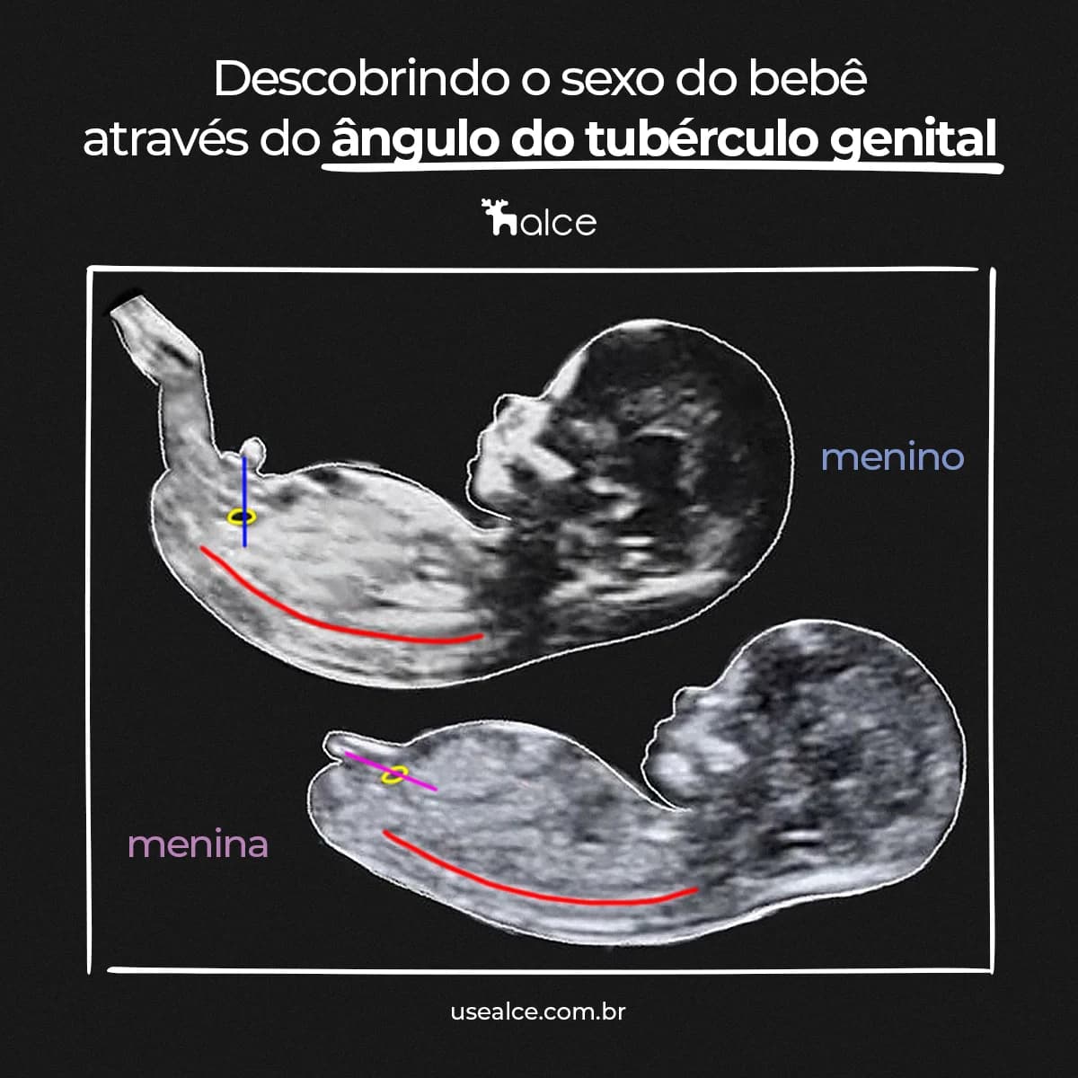 Sexo do bebê através do tubérculo genital vamos descobrir?